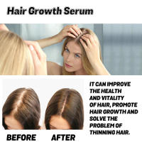 Previene la caída, nutre el cabello, cuidado del cuero cabelludo, esencia densa para el cuidado del cabello - details 6