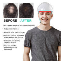 Casco de Crecimiento del Cabello Infrarrojo KTS Inalámbrico Recargable para Reparar Folículos Dañados y Promover el Crecimiento del Cabello - details 0