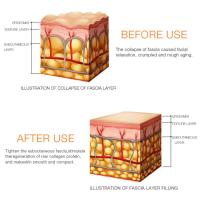 Máquina ultrasónica para rejuvenecimiento de la piel, masajeador Facial, estiramiento Facial, antiarrugas, dispositivo de belleza, Min HIFU - details 10