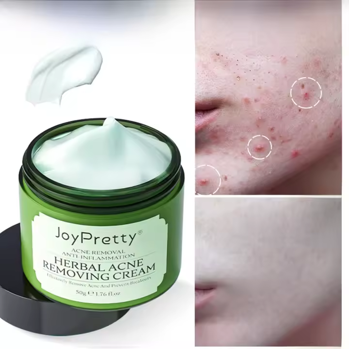 Crema Facial a base de hierbas para el acné, eliminación de marcas de espinillas, Control de aceite, crema hidratante para el rostro, cremas faciales suaves, productos para el cuidado de la piel JoyPretty - 1
