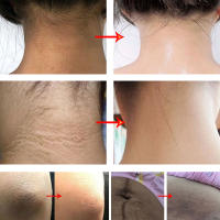 Crema Blanqueadora Elimina Melanina, Aclara Tus Piernas, Axilas, Caderas, Manzanas - details 15