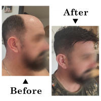Prótesis capilar para hombres, Base de piel ultrafina de 0,03mm, peluca masculina, cabello humano Natural, sistema de cabello Invisible - details 8