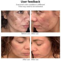 Crema Blanqueadora Efectiva para Manchas Negras Anti-Manchas, Desvanecimiento de Pigmentación, Iluminación del Piel Herramienta de Cuidado de la Piel Corporal de Belleza - details 6