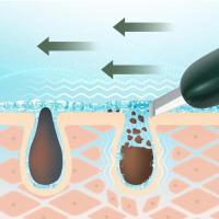 Herramienta de Eliminación de Puntos Negros y Blancos Portátil Mini Exfoliador para Limpieza de Piel Espejo Profundo para Limpieza de Poros - details 9