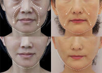 Suero de pulpa cruda de arroz, esencia para la cara con ácido hialurónico, nutritivo, hidratante, blanqueador, antiarrugas, ilumina el cuidado de la piel Facial suave - details 1