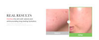 exosome cica cream