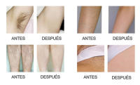 Vancostar-máquina de depilación láser, depiladora IPL profesional, depilación permanente, recortadora de Bikini sin dolor con foto eléctrica LCD - details 13