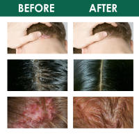 Cuero cabelludo limpieza profunda folículos caspa reparación cabello suavizante esencia de cuidado - details 9
