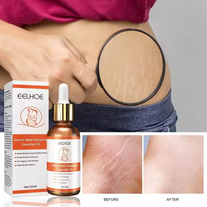 Removedor de estrías, aceite de reparación de cicatrices de maternidad, aceite de tratamiento para el cuidado de la piel, reparación de estrías, mejora la elasticidad, firmeza de la piel - 1