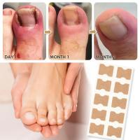 Pegatinas de corrección de uñas encarnadas, parches correctores para tratamiento de paroniquia, herramientas de pedicura, 10/20 piezas - details 2
