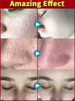 Crema Reductora de Poros de Ácido Salicílico Adiós a los Pulgares, Reparación de Piel, Estiramiento - details 13