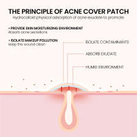 Parche de Acné Tratamiento Efectivo para Manchas de Acné Reparación de Piel Cubierta de Acné - details 5